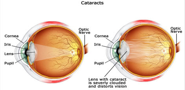 Cataract Care at Sanjivini Eye Centre