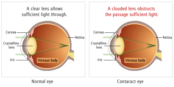 Eye examination and treatment at Sanjivini Eye Centre
